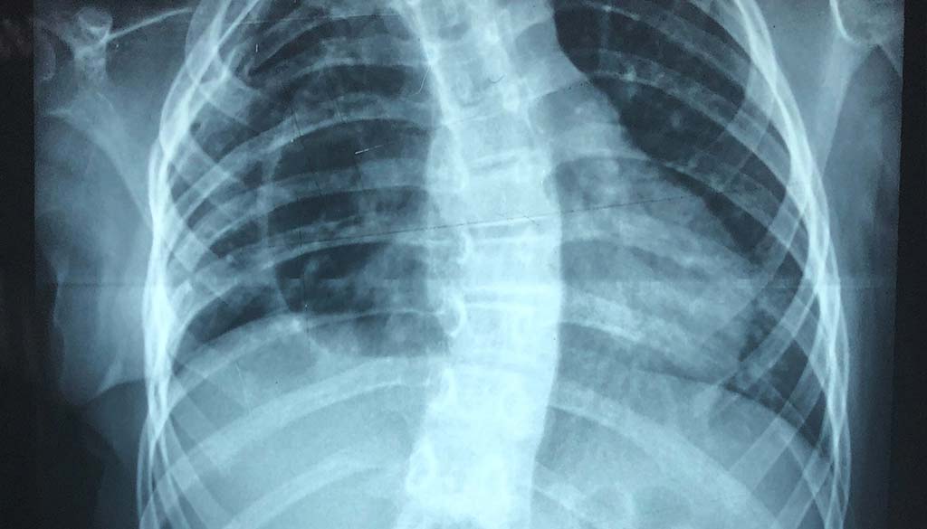 scoliosis