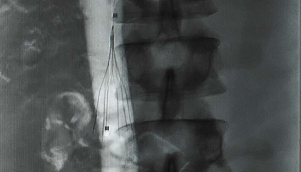 ivc filter